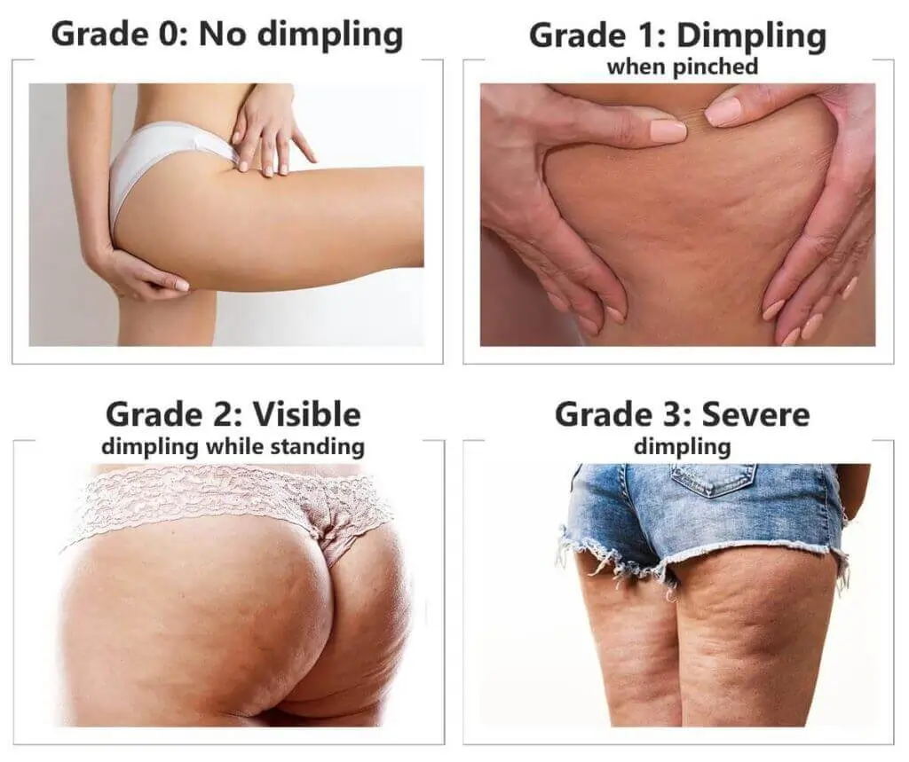 Representation of the stages of cellulite development Oxshott